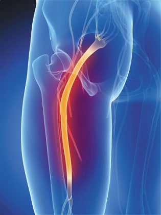 Sciatica Leg Pain Questions