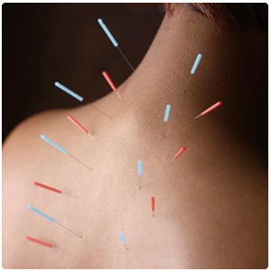 Benefits of Acupuncture for Pain Management